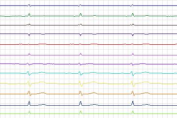s0291lre-patient117 thumbnail