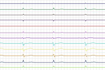 s0292lre-patient117 thumbnail