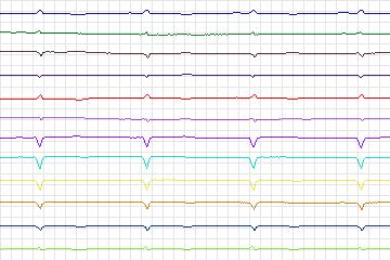 s0294lre-patient158 thumbnail