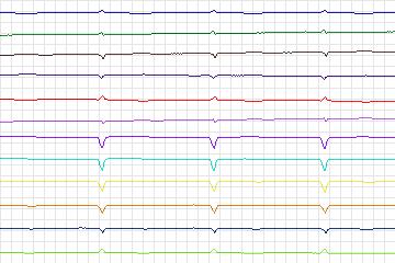s0295lre-patient158 thumbnail