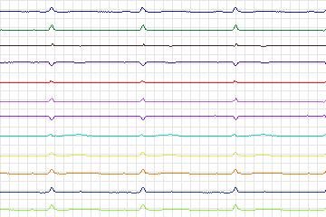 s0296lre-patient085 thumbnail