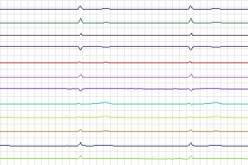 s0298lre-patient085 thumbnail