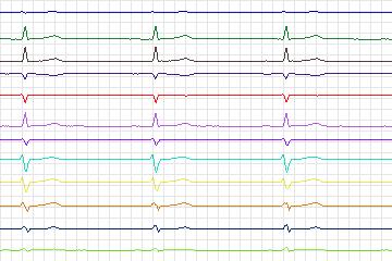 s0299lre-patient156 thumbnail