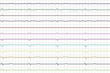 s0301lre-patient155 thumbnail