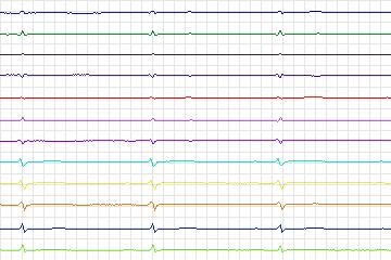 s0302lre-patient116 thumbnail