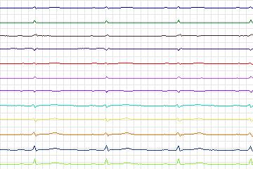 s0308lre-patient182 thumbnail