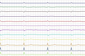 s0310lre-patient194 thumbnail
