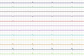 s0311lre-patient121 thumbnail