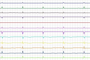 s0316lre-patient086 thumbnail