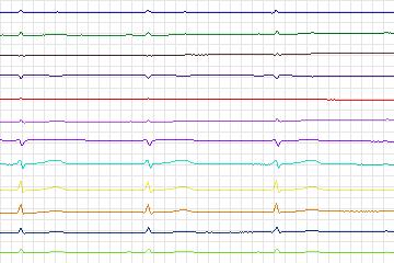 s0318lre-patient072 thumbnail