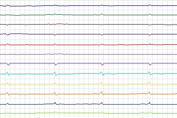 s0321lre-patient087 thumbnail