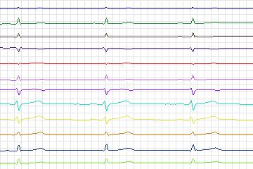 s0322lre-patient165 thumbnail