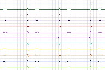 s0325lre-patient174 thumbnail