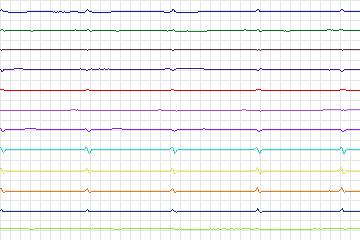 s0326lre-patient087 thumbnail