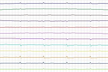 s0330lre-patient087 thumbnail