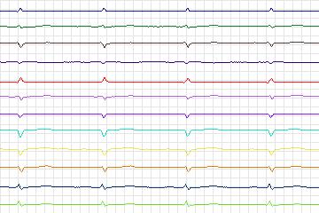 s0331lre-patient120 thumbnail