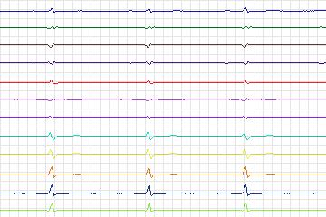 s0333lre-patient143 thumbnail