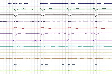 s0335lre-patient148 thumbnail