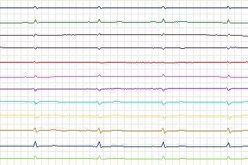 s0339lre-patient088 thumbnail