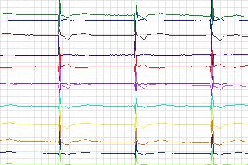 s0341lre-patient144 thumbnail