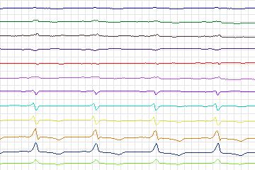 s0351lre-patient142 thumbnail
