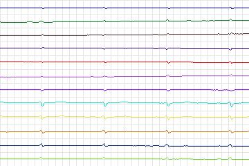 s0354lre-patient092 thumbnail