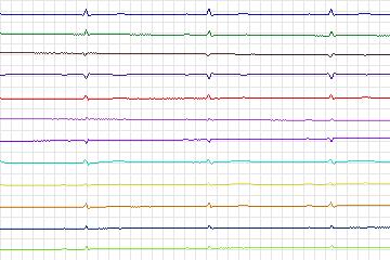 s0359lre-patient089 thumbnail