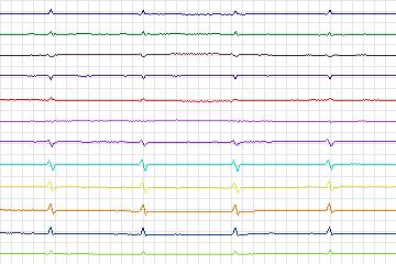 s0363lre-patient184 thumbnail