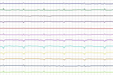 s0370lre-patient094 thumbnail