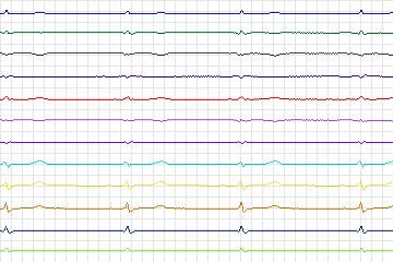 s0375lre-patient093 thumbnail
