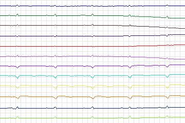 s0376lre-patient094 thumbnail