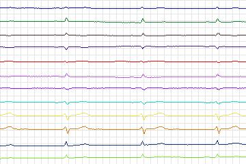 s0377lre-patient095 thumbnail