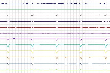 s0381lre-patient096 thumbnail