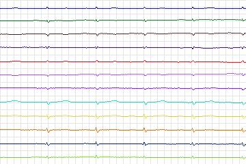 s0386lre-patient098 thumbnail