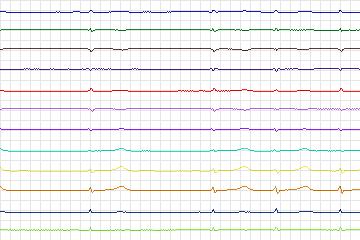 s0389lre-patient098 thumbnail