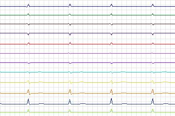 s0390lre-patient159 thumbnail