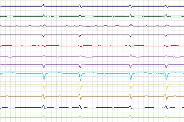 s0391lre-patient153 thumbnail