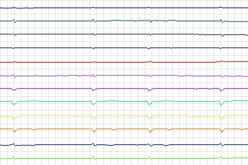s0394lre-patient097 thumbnail