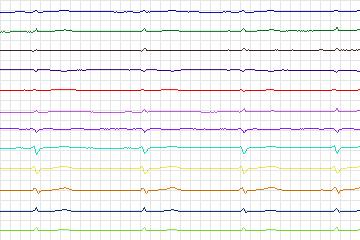 s0402lre-patient198 thumbnail