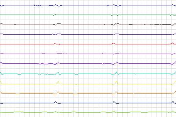 s0403lre-patient197 thumbnail