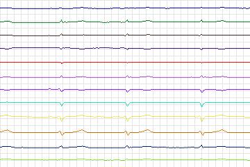 s0415lre-patient198 thumbnail