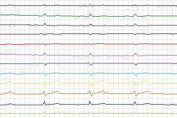 s0417lre-patient095 thumbnail