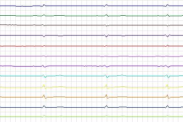 s0418lre-patient090 thumbnail
